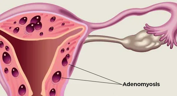 what is adenomyosis